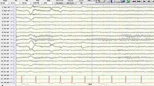 研究人員在睡眠實(shí)驗(yàn)室的兩個(gè)不同夜晚獲得了17名健康人的腦電圖記錄